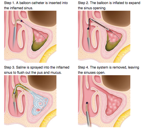 Balloon Sinuplasty for Sinusitis