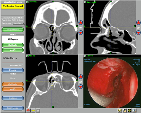 image guided sinus surgery phoenix