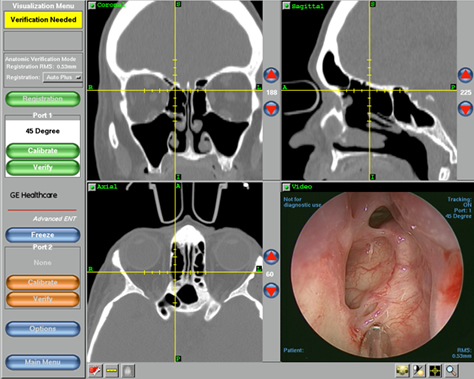 Sinus Surgery Arizona Sinus Center