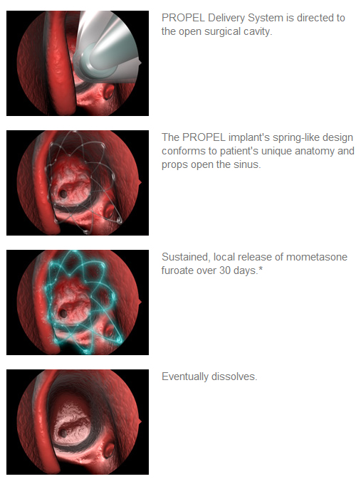 How Propel for the Sinuses work