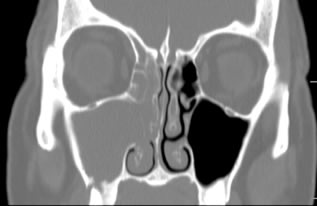 Odentogenic Rhinosinusitis